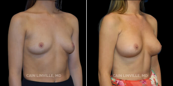 Patient 16 3/4th Right Side View Breast Augmentation Linville Plastic Surgery
