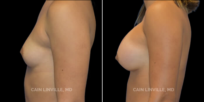 Patient 17 Right Side View Breast Augmentation Linville Plastic Surgery