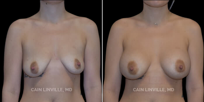 Patient 18 Front View Breast Augmentation Linville Plastic Surgery