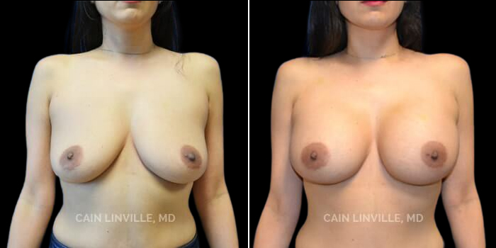 Patient 19 Front View Breast Augmentation Linville Plastic Surgery
