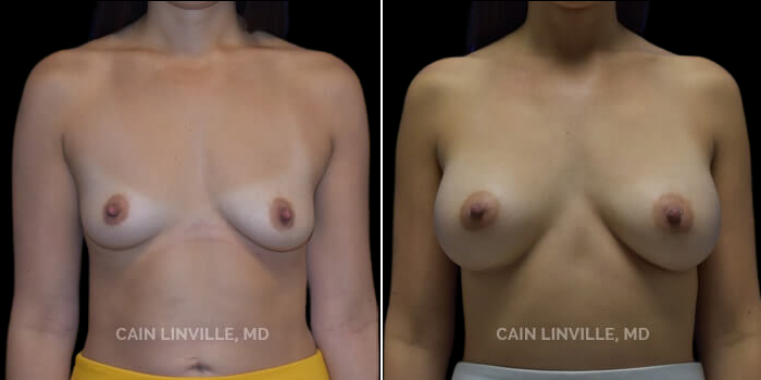 Patient 21 Front View Breast Augmentation Linville Plastic Surgery