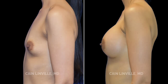 This young woman desired an increase in size from a very small A cup to a full C cup, but wanted to maintain a look that suited her body and still looked natural. Also, she is young and has not had children yet, so an inframammary incision was chosen to avoid the breast tissue and preserve nipple sensation and her ability to breastfeed. 445 cc responsive silicone implant, dual plane 0.5 pocket, inframammary incision. These pictures at 6 months show perfect implant position and the ultimate transformation from minimal breast tissue to a perfect figure. The implants also fit her petite frame because their projection is extra full which minimizes any widening of the chest. If anything, her results will mature and look more natural over time.