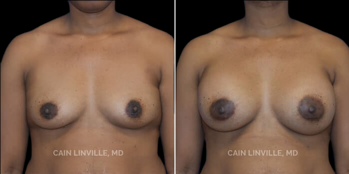 Patient 22 Front View Breast Augmentation Linville Plastic Surgery