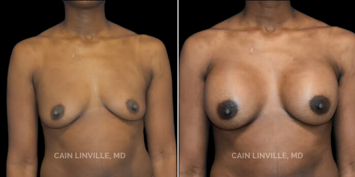 Patient 23 Front View Breast Augmentation Linville Plastic Surgery