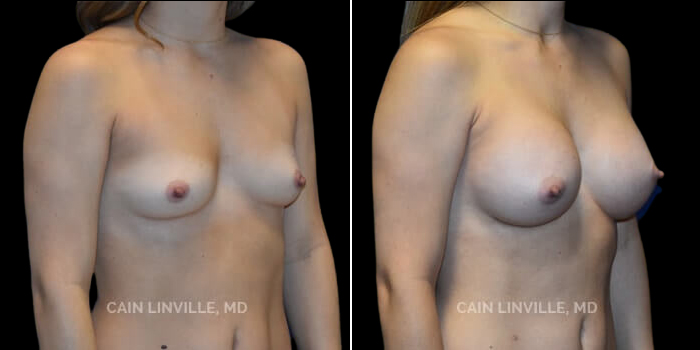 Patient 25 3/4th Right Side View Breast Augmentation Linville Plastic Surgery