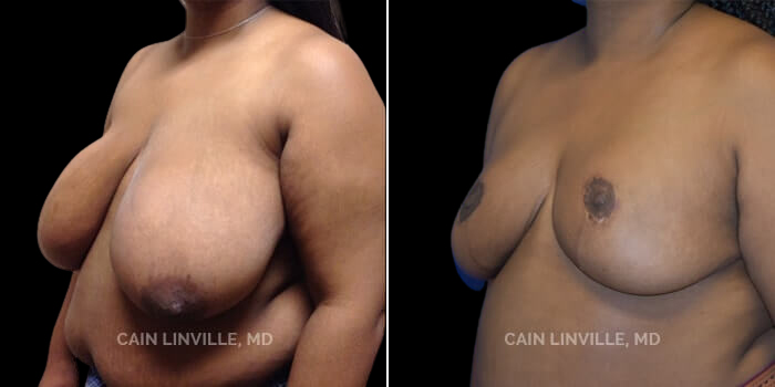 Patient 05 3/4th Left Side View Breast Reduction Linville Plastic Surgery