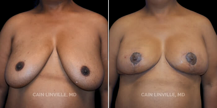 Patient 04 Front View Breast Reduction Linville Plastic Surgery
