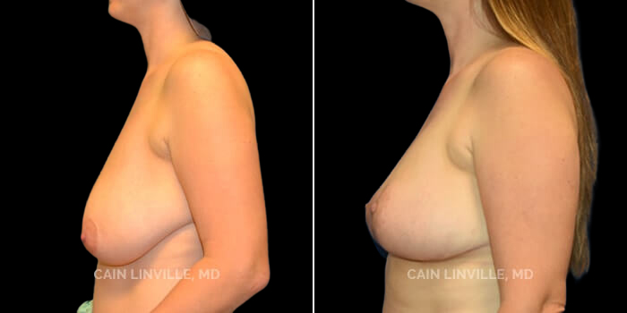 Patient 02 3/4th Left Side View Breast Reduction Linville Plastic Surgery