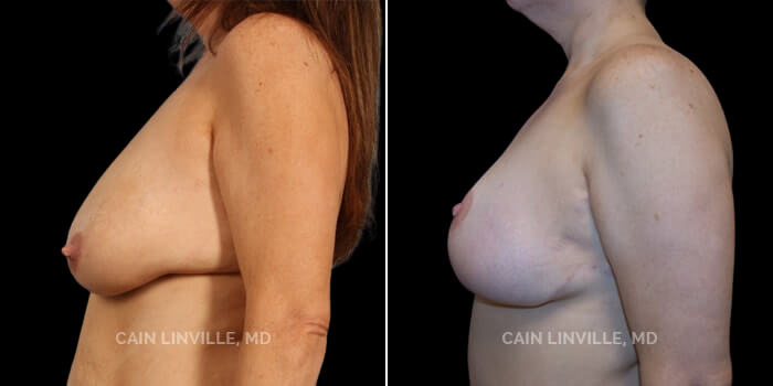 Patient 01 Right Side View Breast Reduction Linville Plastic Surgery