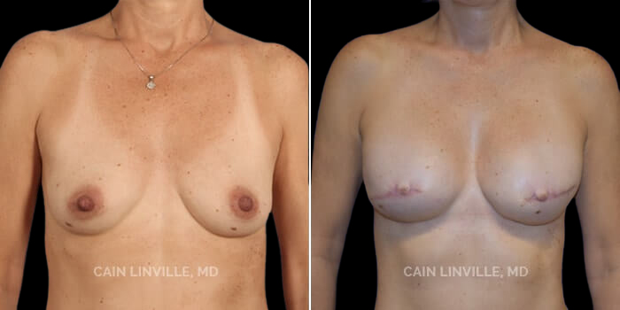 This petite 55 yo woman developed breast cancer and underwent a classic two-stage implant-based approach, using a Tissue Expander at the time of her skin-sparing mastectomy, placed in the pre-pectoral plane, and then eventually having them replaced for an implant along with fat-grafting. Tissue expanders were initially chosen because the patient wanted to have a slightly larger breast than when she started, and the tissue expander was used to help increase the size of the breast skin envelope. Her final implants are tear-drop shaped, anatomic implants. Finally, she had nipple reconstruction followed by 3-D areola tattooing. Her results show what can be achieved on a small frame and also demonstrate a very well done areola tattoo for a great overall result, shape, and look.