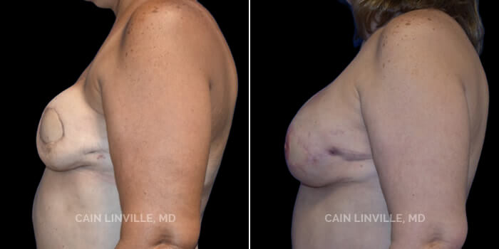This 45 yo woman underwent bilateral mastectomies and immediate DIEP flaps, which is depicted in her pre-op photos (her pre-op pictures are missing!). This is a good example, however, of the contour problems that can be seen after DIEP flaps due to the skin flaps overlying them being thin – she just had a mastectomy. Her postop pictures though, show how filling in the tissue with fat helps to blend in and erase those contour problems creating a very nice natural result. She also recently had a very small revision in order to enhance her symmetry, and her results are even better than shown here. We will post those pictures in just a few months. Also note, her nipples were created via surgery, and then she had 3-D tattooing which looks uber-natural.