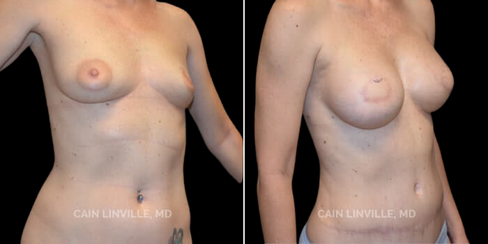 This young 40 yo woman had previously had left breast cancer treated with a lumpectomy and radiation several years ago. She then recurred, and opted for bilateral mastectomies. Due to the radiation, she underwent immediate DIEP flap reconstruction, and followed this up with implant placement and fat grafting. She was too thin to be able to achieve her size goal with fat grafting alone, hence the implant. She has opted not to do nipple reconstruction, and instead is going to get a floral tattoo, which we are anxious to see and show. I do like that her result is a good demonstration of how the DIEP flap can reconstruct the breast tissue so to speak, and if followed up with an implant, it can give a slightly enhanced look, almost like an augmentation.