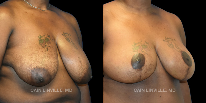 48 year old female underwent three stage reconstructive surgery. First consisted of a bilateral breast lift, followed with a bilateral DIEP flap. Ending with bilateral fat grafting