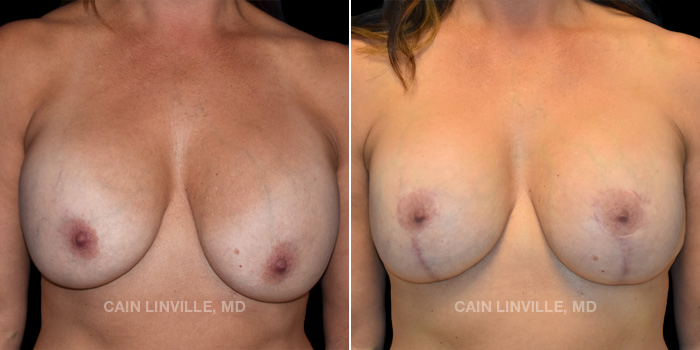 This 54 year old patient wanted a fuller and more lifted appearance to her natural breast. We did a mastopexy with placement of implants. These photos are 1 year post op.