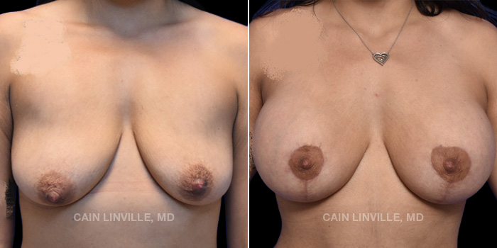 Patient 12 Front View Breast Lift Linville Plastic Surgery