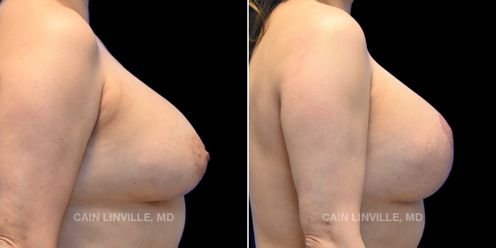 Patient 11 Right Side View Breast Lift Linville Plastic Surgery