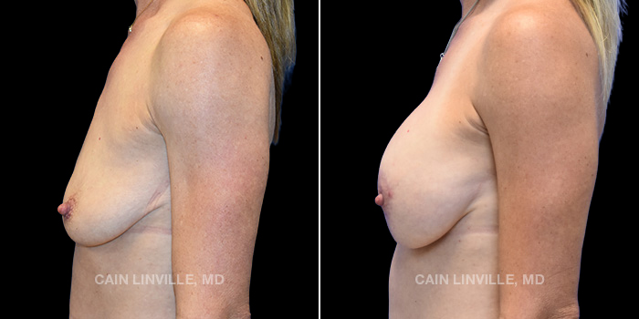 This patient is a 41 year old female who received a breast lift with implants. These photos are 3 months post op.