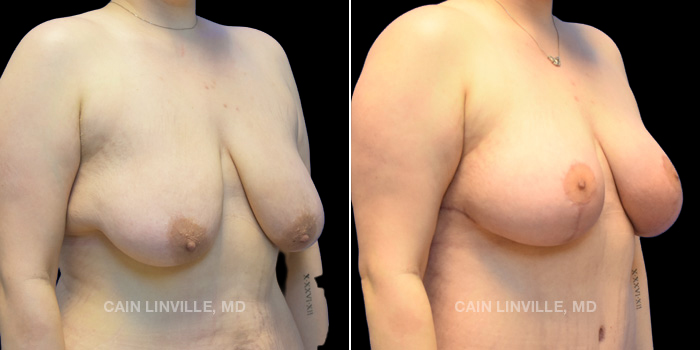 28 years old Procedures Depicted Breast lift no implants