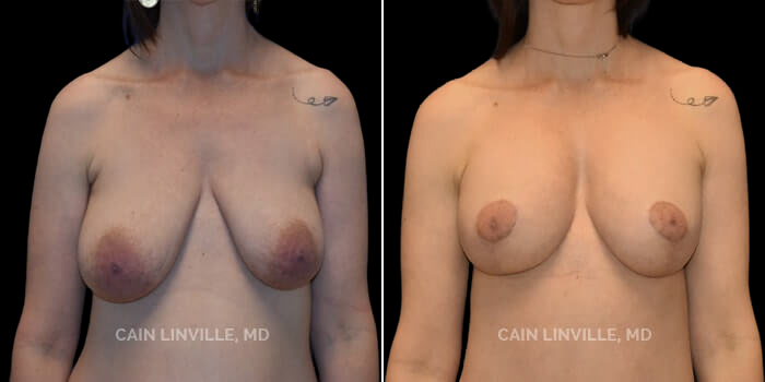 This is a 40 year-old woman who after having multiple children had breast sagging and deflation. She desired a rejuvenated appearance and a small amount of upper pole fullness that would be long-lasting. She underwent a bilateral breast lift with simultaneous augmentation, using a 200 cc Soft Touch Cohesive implant. As you can see she has a much improved shape and appearance, along with significant but reasonable upper pole fullness. This surgery was also part of a mommy makeover, with a lipoabdominoplasty.