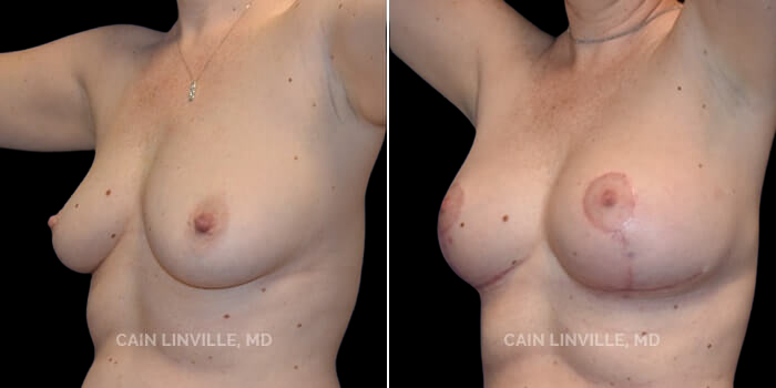 Patient 1 3/4th Left Side View Breast Lift Linville Plastic Surgery