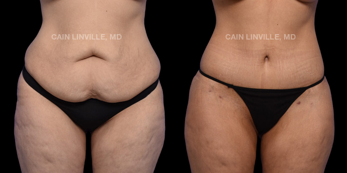 This patient is a 35 year old female who received a tummy tuck in combination with lipo to her entire abdomen, back, flanks, bra-line, inner and outer thighs. She also received a buttock lift. These photos are 6 months post op.