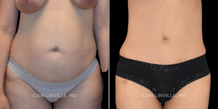 This 40 year-old mother of 2 had fairly severe rectus diastasis and excess skin, along with excess adipose. Her goal was to have a flat tummy and to feel sexy again. She underwent a lipoabdominoplasty as part of her mommy makeover, including rectus plication, and breast aug/lift (not shown here). She has a great result, with a low scar, and a nice belly button, and additionally, an enhancement of her lateral abdominal musclular shadow, due to a subtle amount of abdominal etching that was performed.