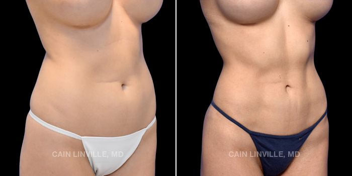 This patient is a 22 year old female who received abdominal etching through liposuction to her abdomen, flanks, and back with fat grafting to her buttocks (mini BBL). These photos are 6 months post op.