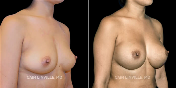 Patient 09 3/4th Right Side View Breast Augmentation Linville Plastic Surgery