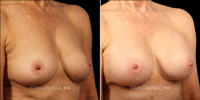 Patient 10 3/4th Right Side View Breast Augmentation Linville Plastic Surgery