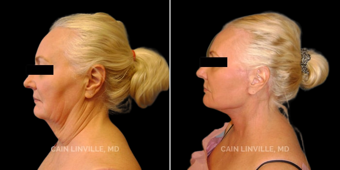 Patient 01 Left View Face and Neck Lift Linville Plastic Surgery