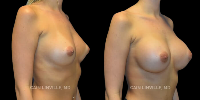 This beautiful patient wanted a subtle but noticeable increase in her breast size and fullness, from a B to a D cup. We chose a 345 cc Soft Touch Cohesive round implant, placed through an infra-mammary incision since she is young and might want to breast feed. She has settled perfectly and has the ideal postop shape and contour.