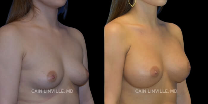 This young woman desired a size that fit her body but wanted a full round look with upper pole cleavage. She wanted to be a full C or D cup. 420 cc gummy bear implant, dual plane 0.5 pocket, inframammary incision. She has a very natural shape with no obvious scar, and a definite increase in her breast volume and a nice round shape to the upper pole of her breast.