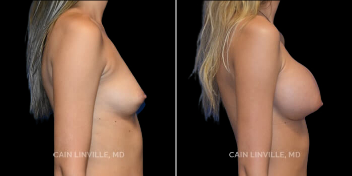 Patient 14 Right Side View Breast Augmentation Linville Plastic Surgery
