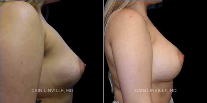 Patient 15 Right Side View Breast Augmentation Linville Plastic Surgery