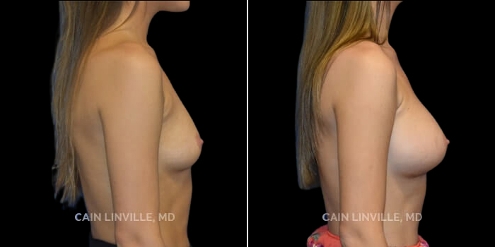 Patient 16 Right Side View Breast Augmentation Linville Plastic Surgery