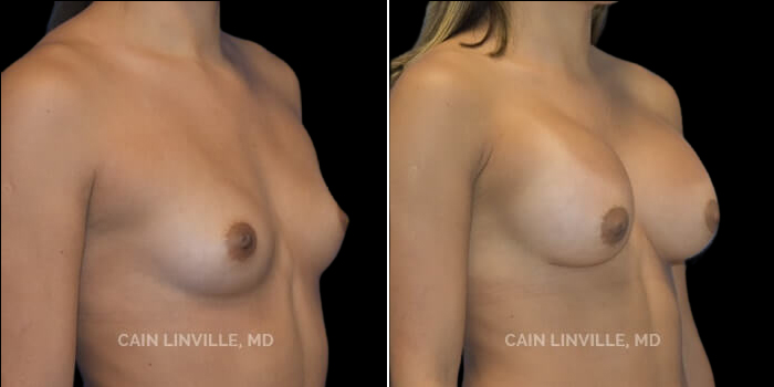 Patient 17 3/4th Left Side View Breast Augmentation Linville Plastic Surgery
