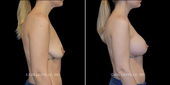 Patient 18 Right Side View Breast Augmentation Linville Plastic Surgery