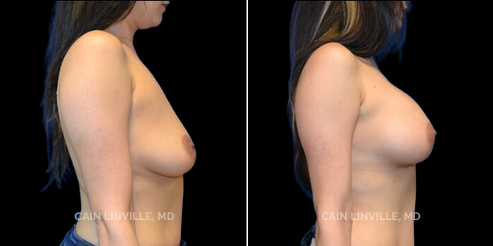 Patient 19 Right Side View Breast Augmentation Linville Plastic Surgery