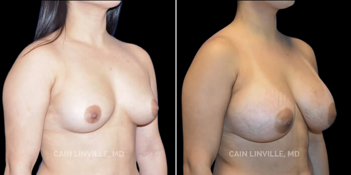 B to D cup and upper pole fullness. This patient desired a significant increase in breast size along with upper pole fullness. 445 cc gummy bear cohesive Natrelle implants were placed in a dual plane I position, through an inframammary incision. She has a very nice result without being too large and with improved fullness throughout the breast.