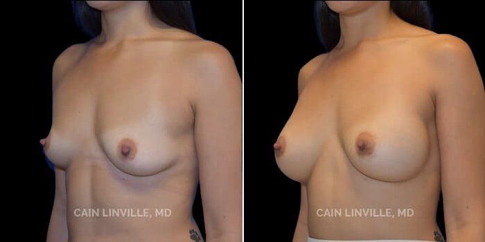 Patient 21 3/4th Left Side View Breast Augmentation Linville Plastic Surgery