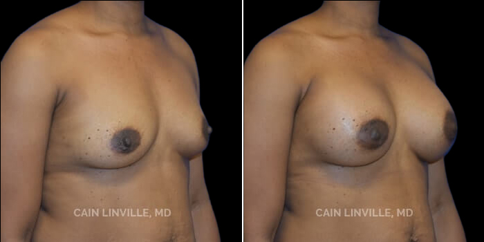 Patient 22 3/4th Right Side View Breast Augmentation Linville Plastic Surgery