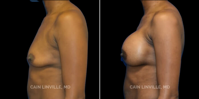 Patient 23 Left Side View Breast Augmentation Linville Plastic Surgery