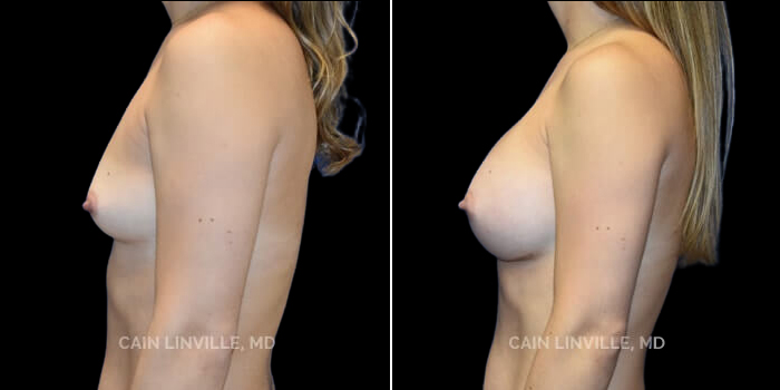 Patient 25 Left Side View Breast Augmentation Linville Plastic Surgery