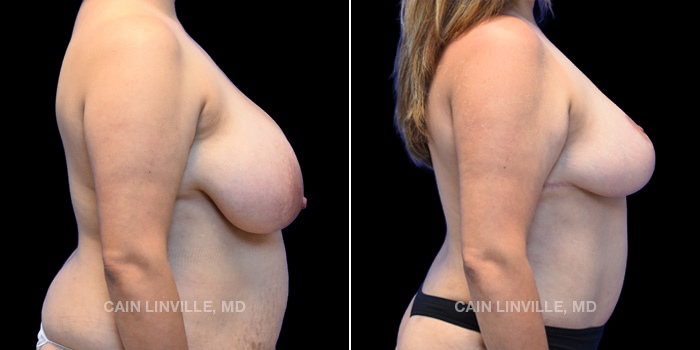 34 years old Procedures Depicted Extended TT, Lipo & BT of Abdomen, Back, Flanks, BraLine, Inner Thighs, Breast Reduction, FG to Butt, BodyTite