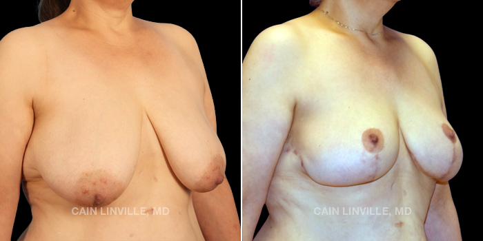52 years old Procedures Depicted Breast Reduction and Lift