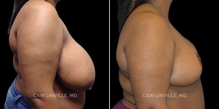 Patient 05 Right Side View Breast Reduction Linville Plastic Surgery