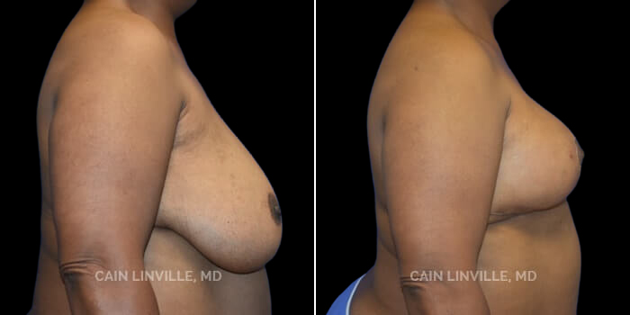 Patient 04 Right Side View Breast Reduction Linville Plastic Surgery