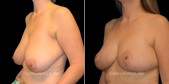 Patient 02 Left Side View Breast Reduction Linville Plastic Surgery