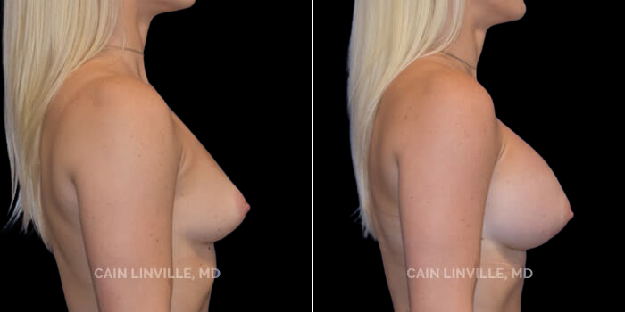 This young woman wanted a full-round look that didn’t need a bra’s support to achieve enhanced cleavage. Her desired increase in size was to go from a B cup to a full D cup. 420 cc highly cohesive silicone implant, dual plane 0.5 pocket, inframammary incision. At 33, she now has the full chest look she wanted that goes well with her frame. Thehighly cohesive implants gave her the roundness and cleavage she’s always wanted while maintaining a natural but augmented look.