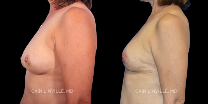 This 50 yo woman underwent a left mastectomy for cancer, but did not want the right breast altered. The tumor was too close to the nipple to spare, so her mastectomy was skin-sparing. She initially had a tissue-expander in place, but opted for a left unilateral DIEP flap. This is a great example of how a DIEP flap, even if used on one side, can help with symmetry, as it appears very natural, and behaves and looks like a normal breast. She later had nipple reconstruction followed by 3-D areola tattooing, and has a near-perfect symmetric result.